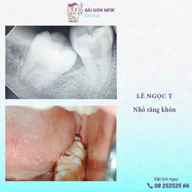 Top 6 Địa chỉ nhổ răng khôn uy tín, an toàn nhất Đà Lạt – Review & Đặt Chỗ 2026